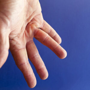 Dupuytren’s Contracture – Causes, Symptoms, and Home Remedies
